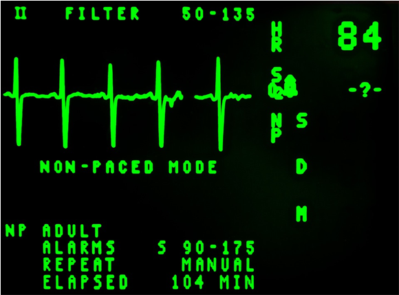 A sample of an EKG