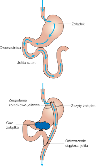 Illustration of a stomach before the bypass and after