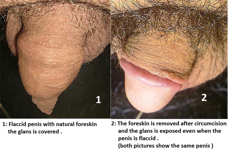 Two pictures show the natural state and the circumcised state of the same penis.