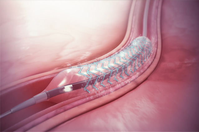 An animation still in pink showing the stent tube inside an artery.