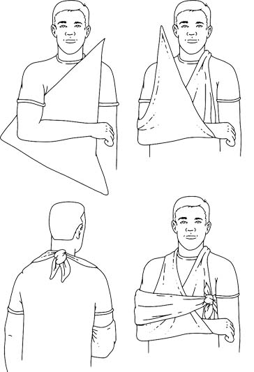 Illustration of the sling-and-swathe technique for treating an arm fracture.